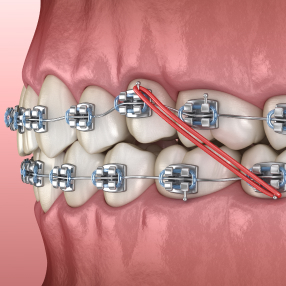Elastiques en orthodontie au cabinet d'orthodontie du Dr Renaud à Neufchateau